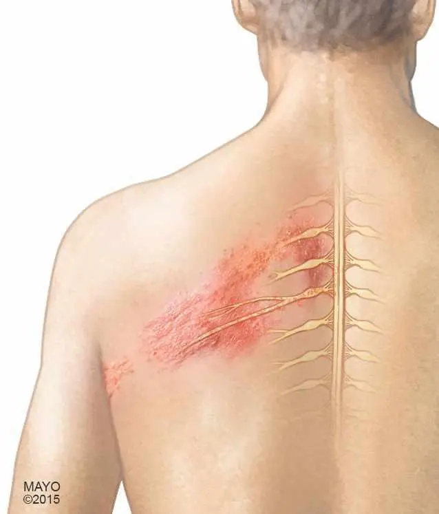 Postherpetic Neuralgia